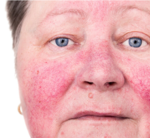 Rosacea Clinical Trial