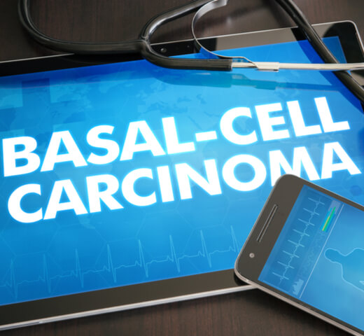 Skin Cancer Clinical Trial