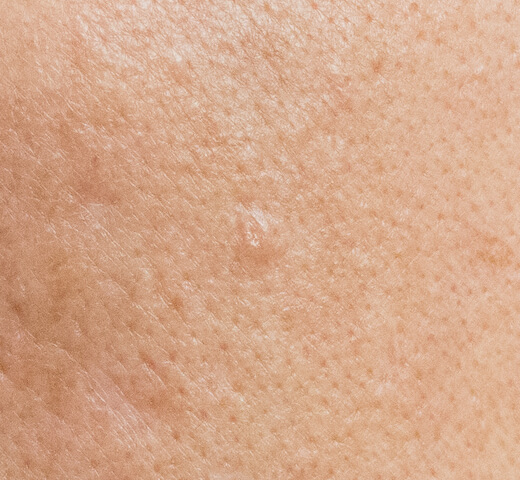 close up of sebaceous hyperplasia
