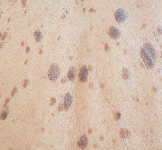 close up of seborrheic keratosis