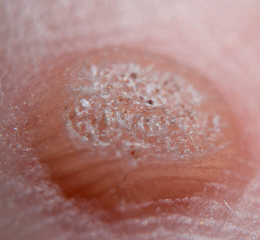 close up of wart