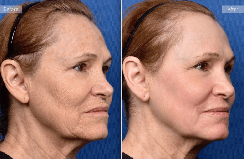 before and after pictures of laser treatment for wrinkles