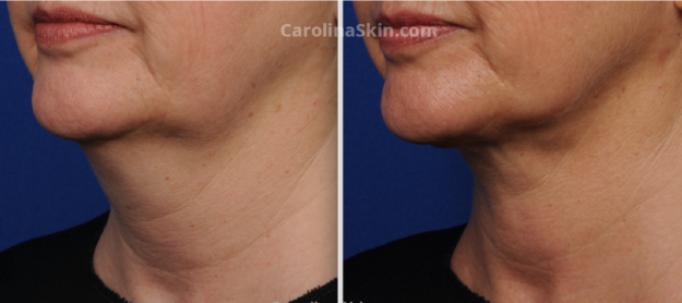 Neck-Liposuction-Patient-Before-After