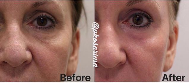 Laser Treatment Before and After