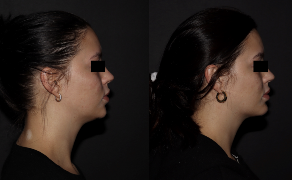 Before and after images on right side of face