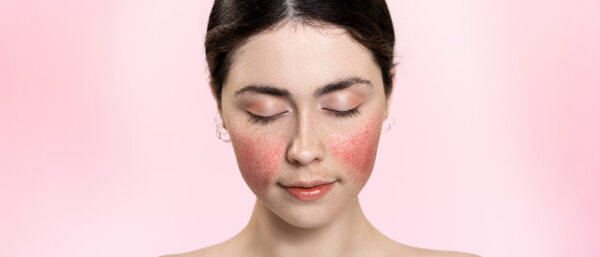 Facial Redness