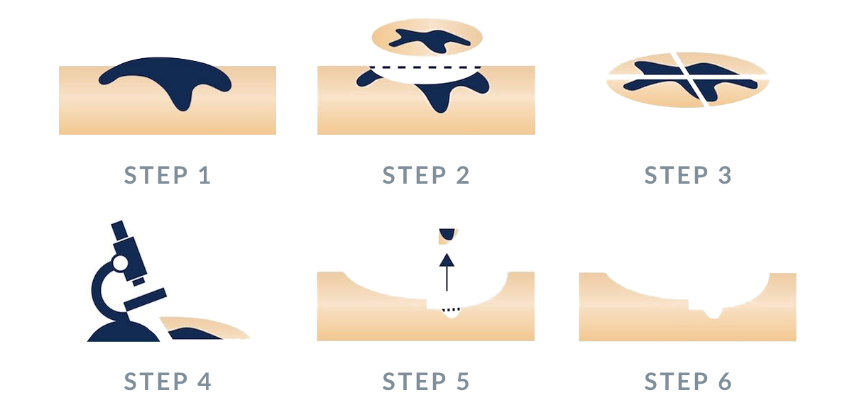 MedDerm – Mohs Surgery, Diagram