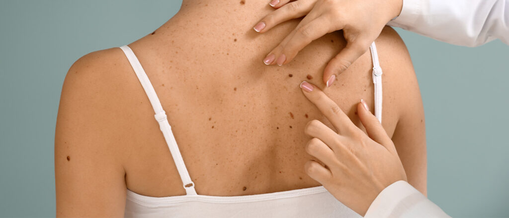 MedDerm-MohsSurgery-Featured-259294611