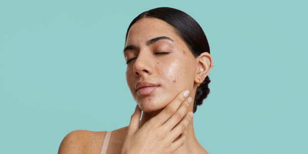 OldSite-Blog-TheBestTreatmentstoCombatAcneScars